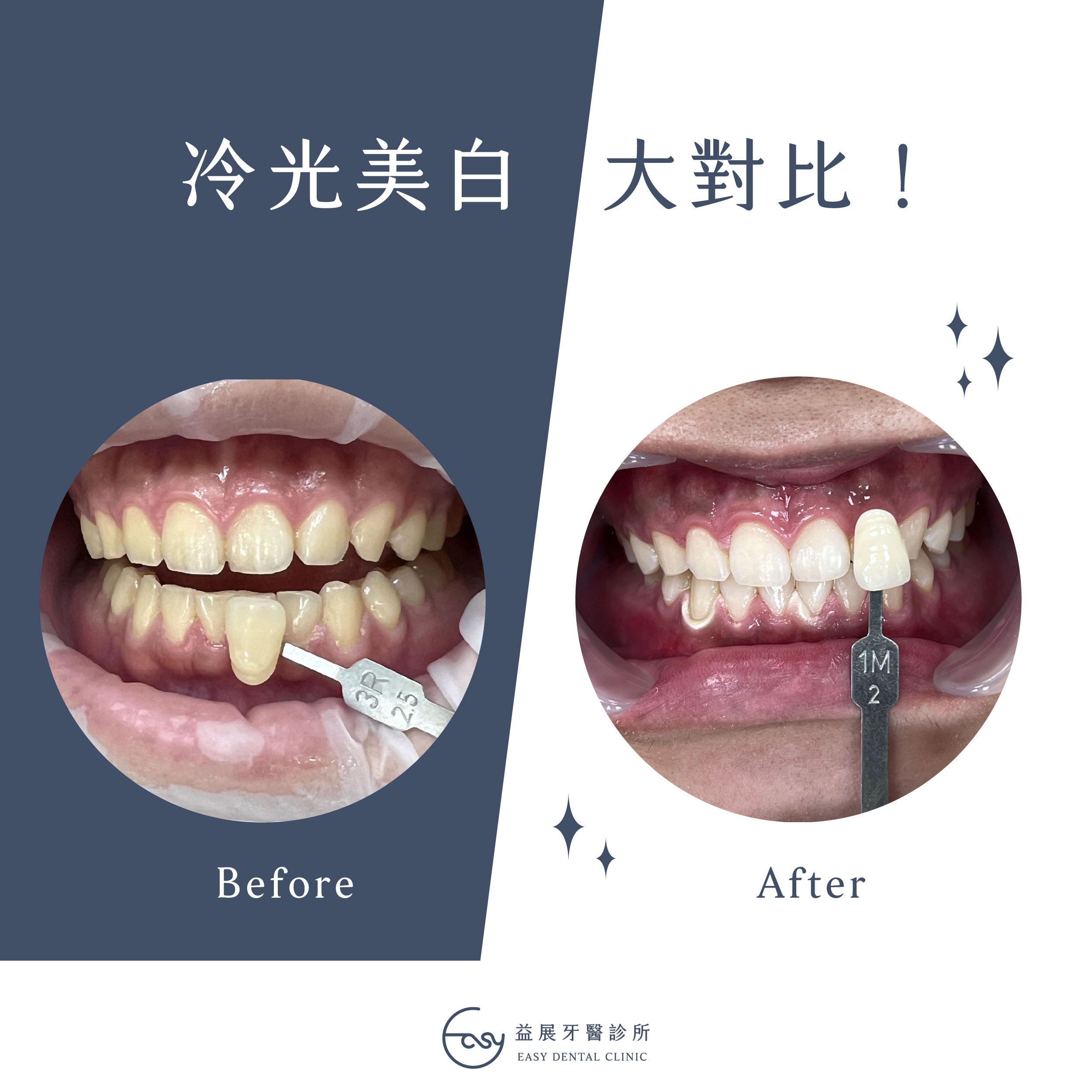 專業冷光美白大對比!