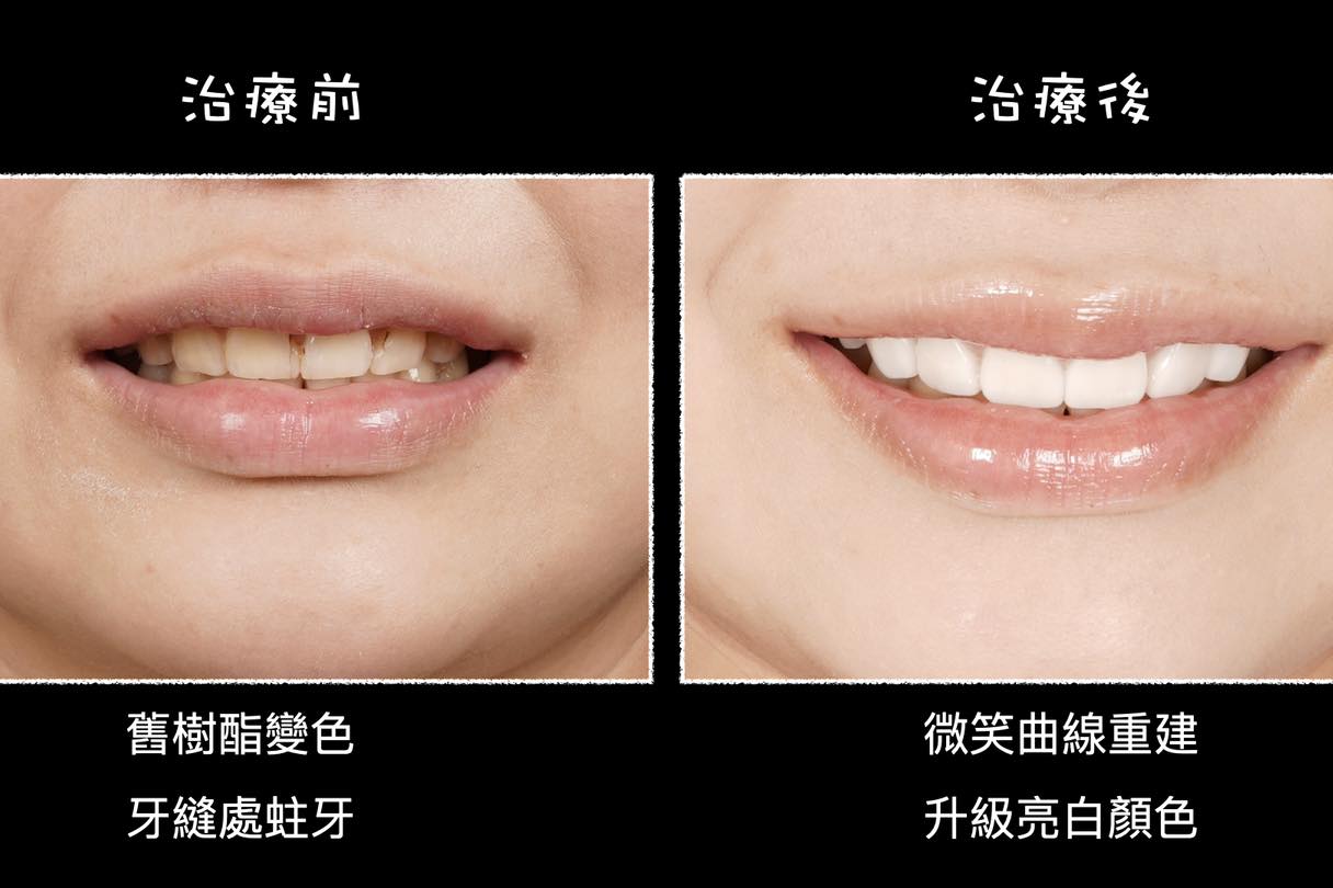 牙齒美白 瓷牙貼片 微笑曲線 前牙美學