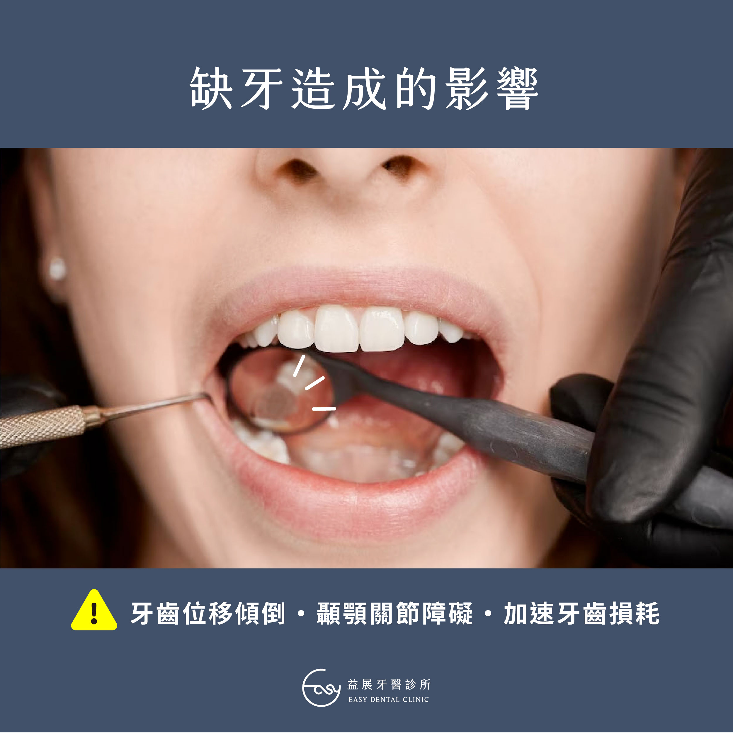 缺牙會有什麼影響?