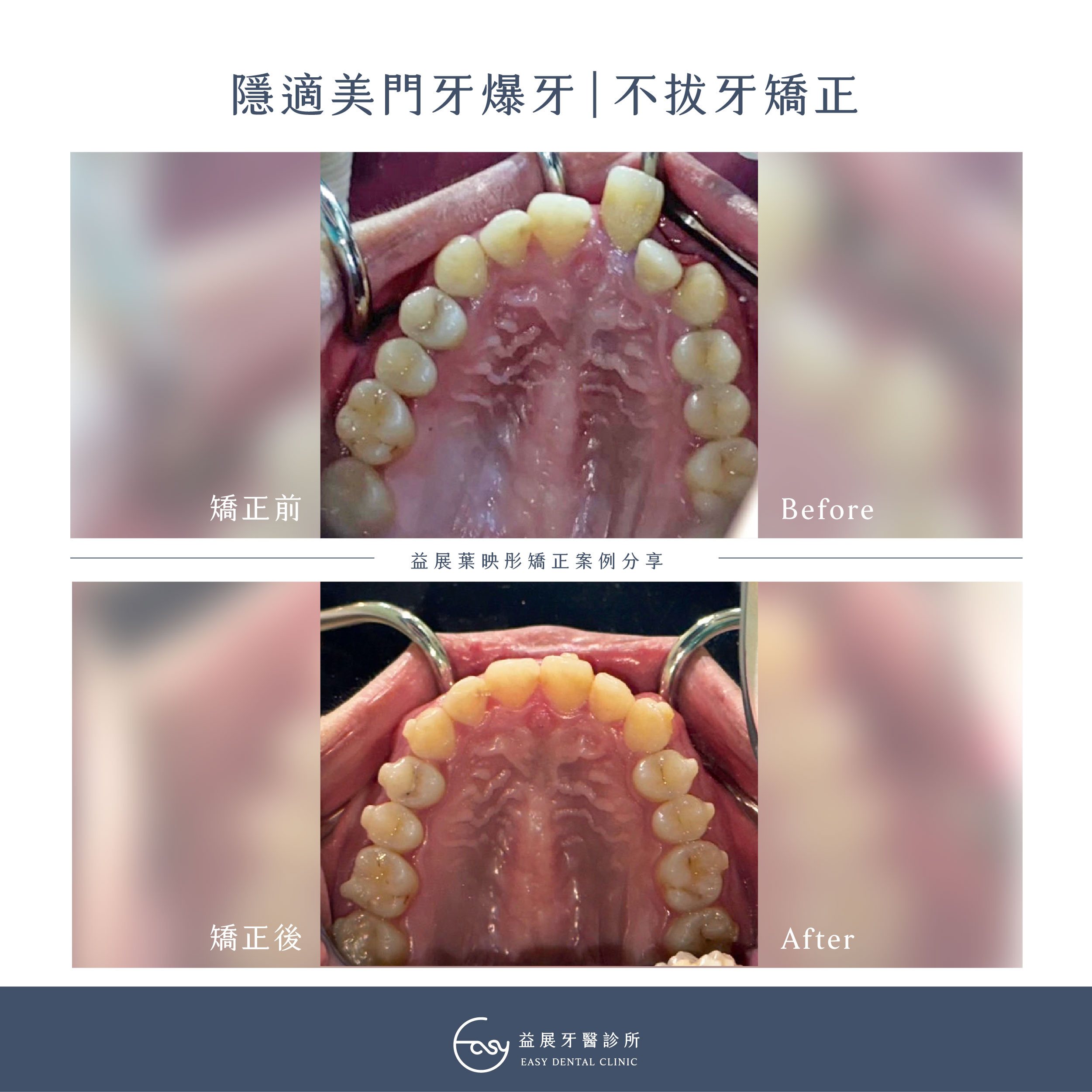矯正不一定要拔牙!?