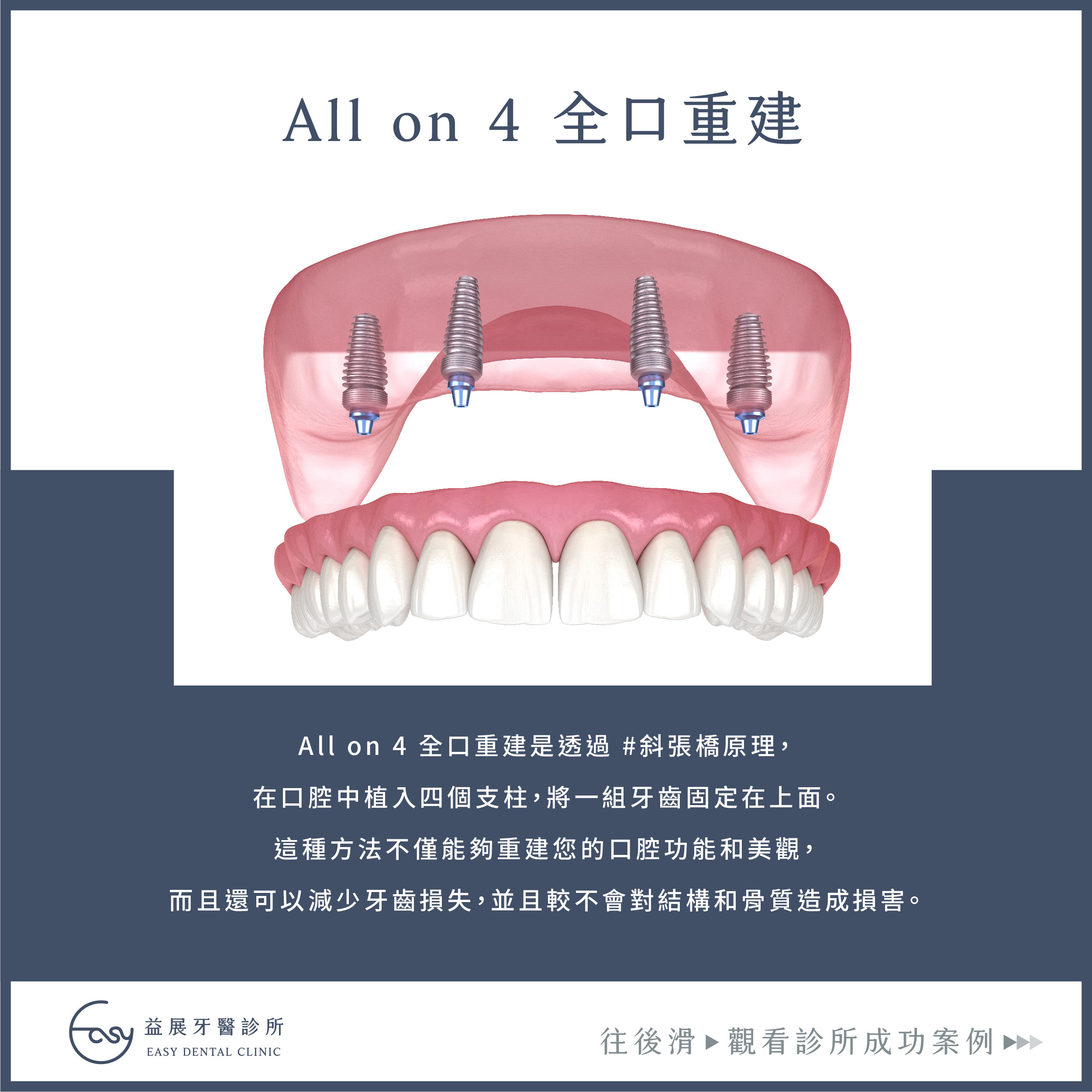 All-On-4 全口重建最快一天完成！