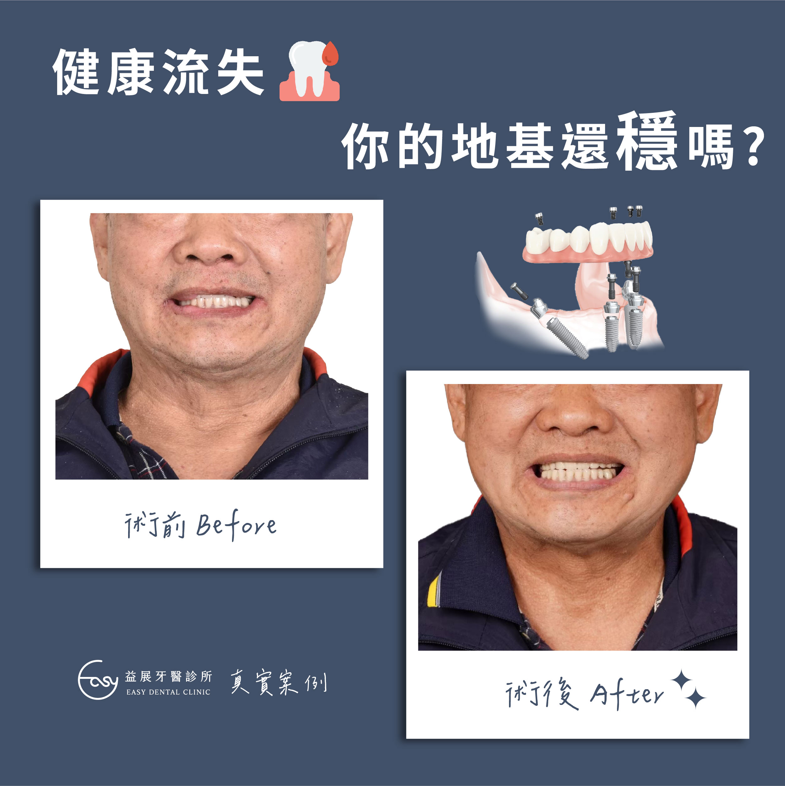 All-on-4全口重建一次到位！ 拒絕一植再植！