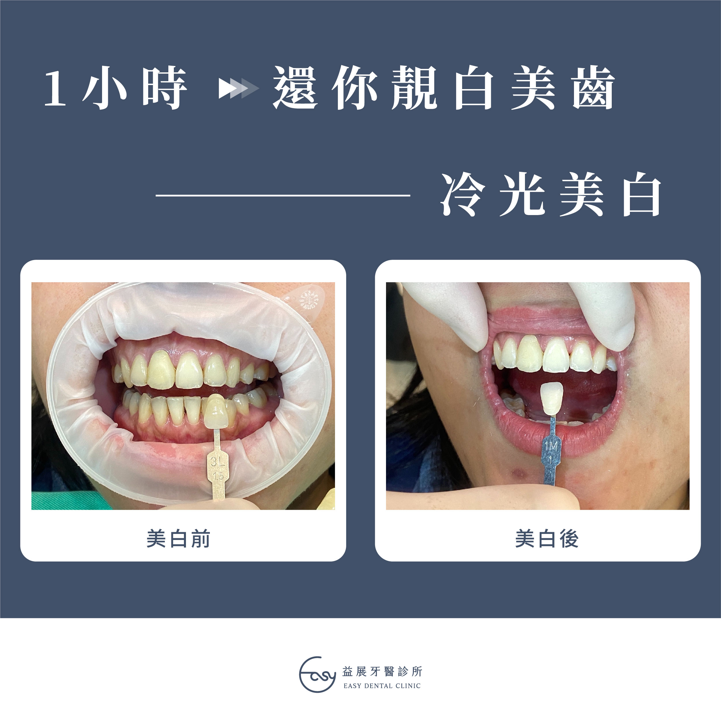 一小時就有感的冷光美白