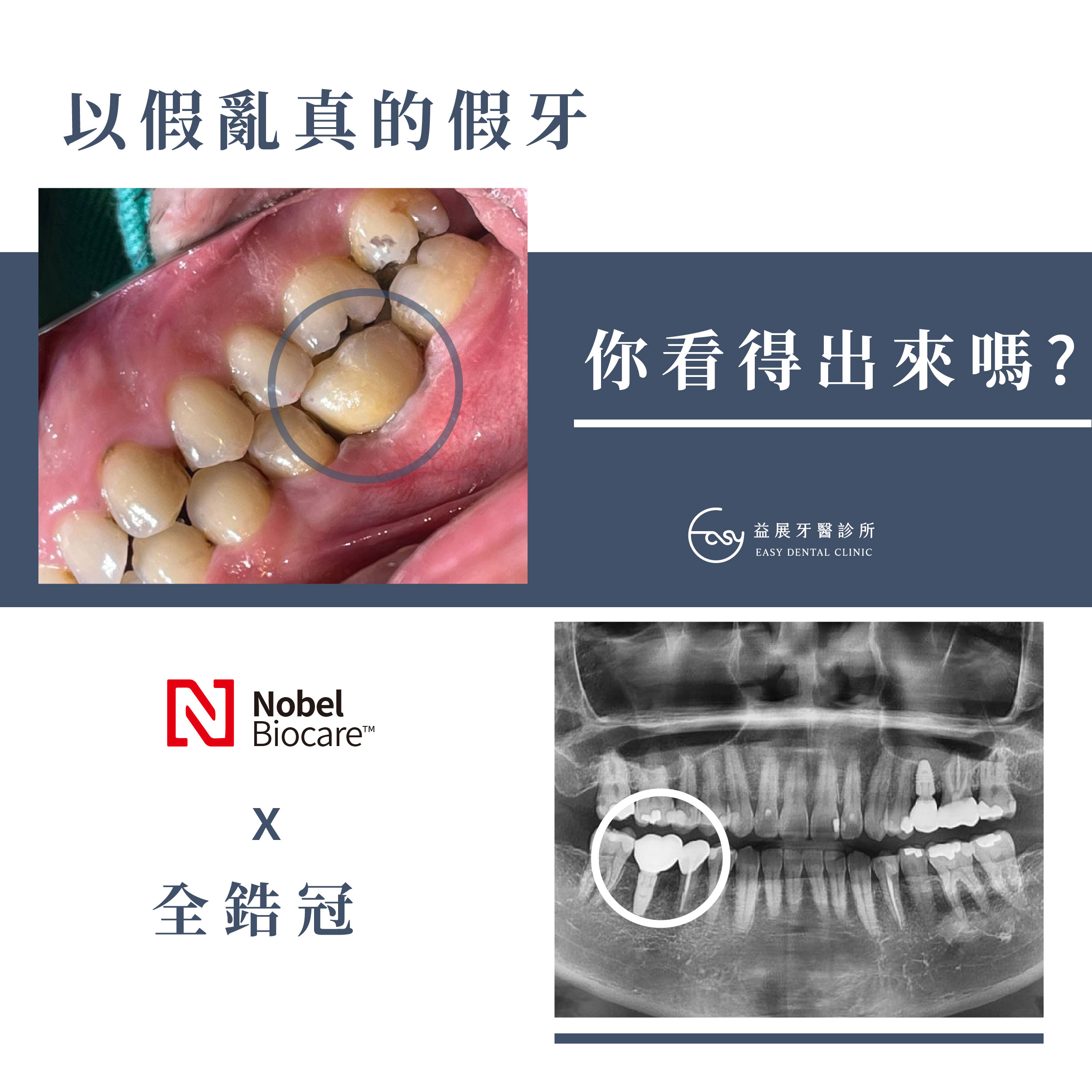 猜猜看，圖中的哪顆牙齒是假牙？