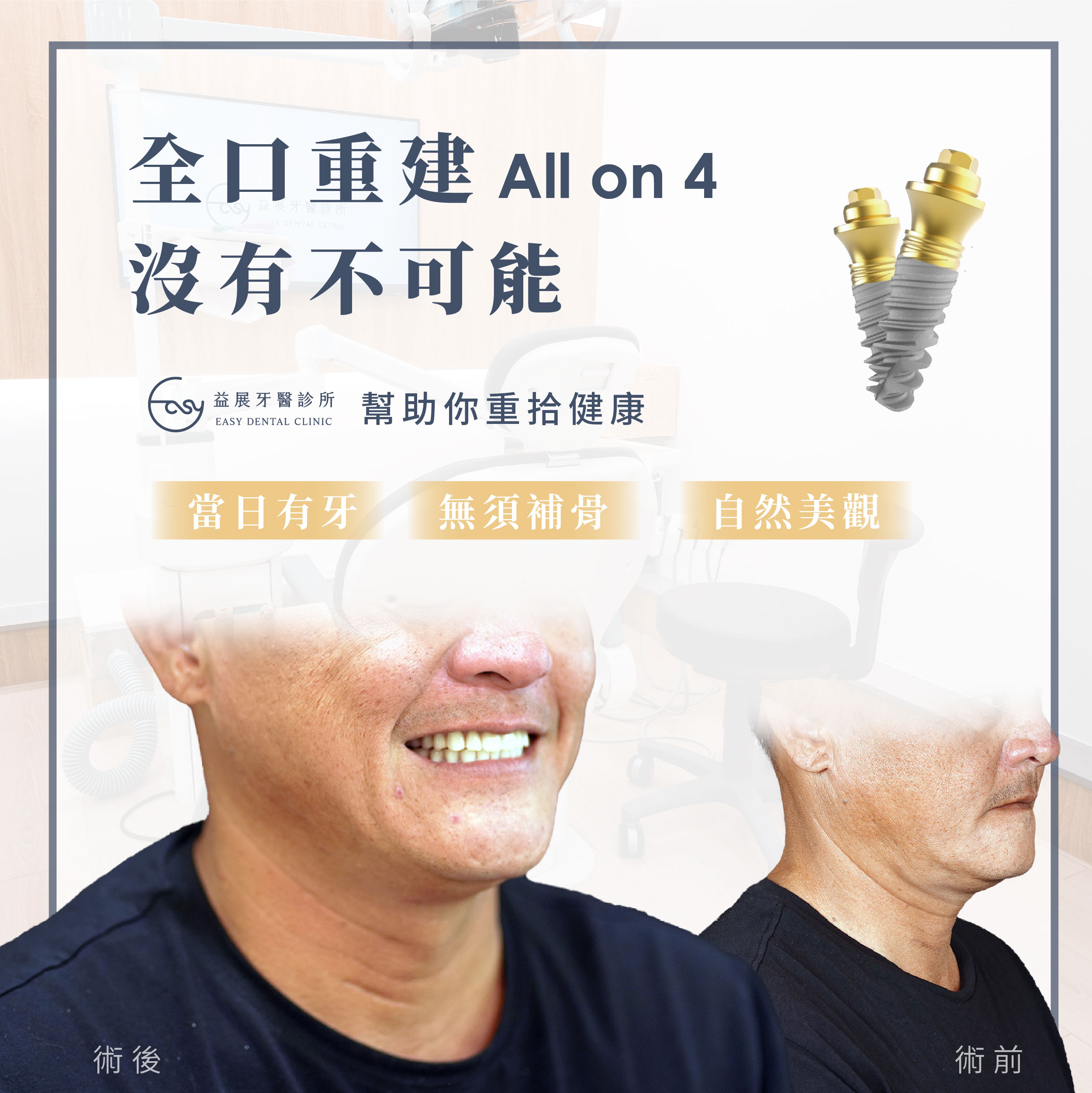 益展All-on-4全面優勢