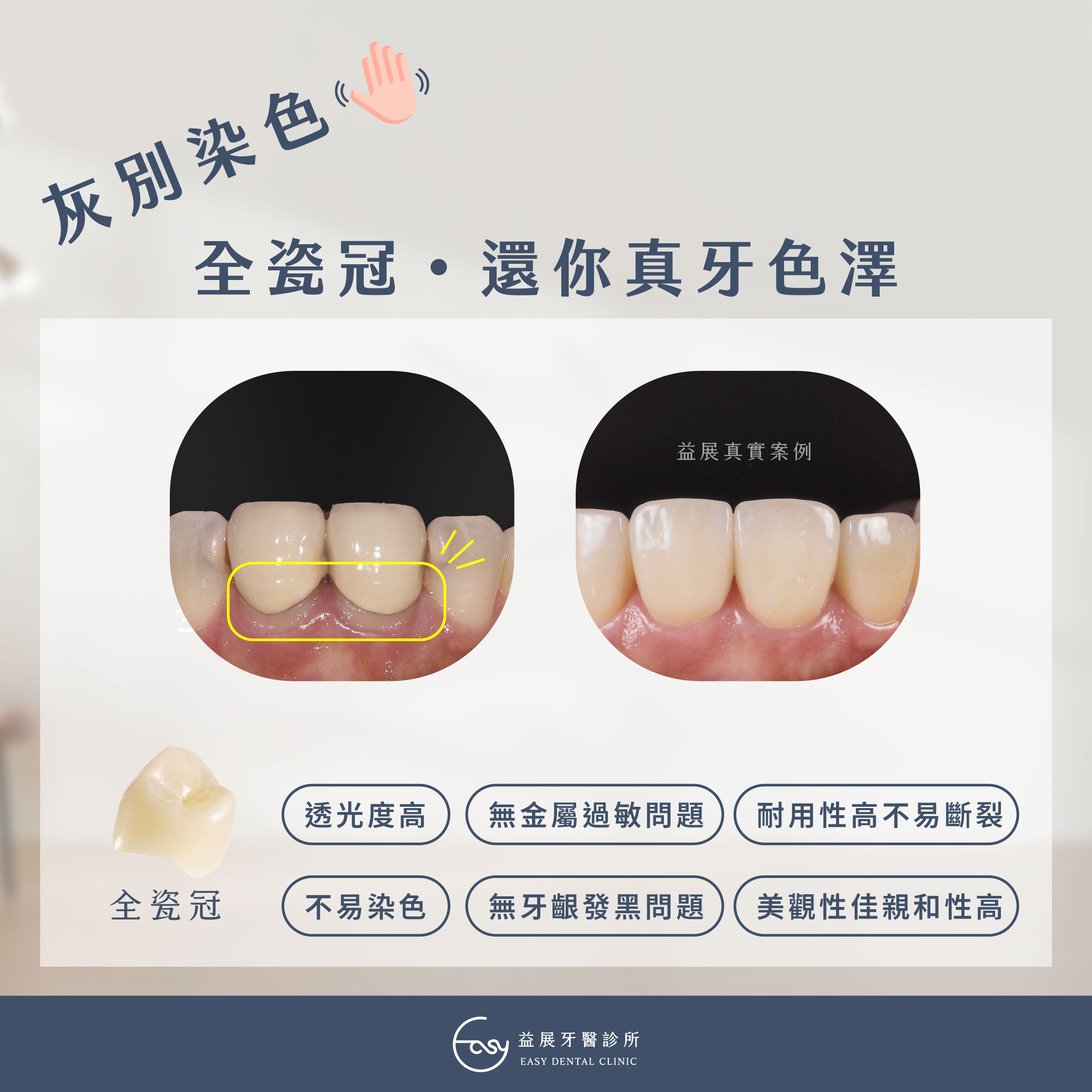 全瓷冠還你真牙色澤!